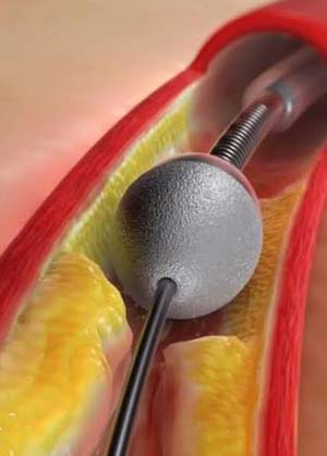 Gloved hands preparing an anatomical heart model for a coronary procedure