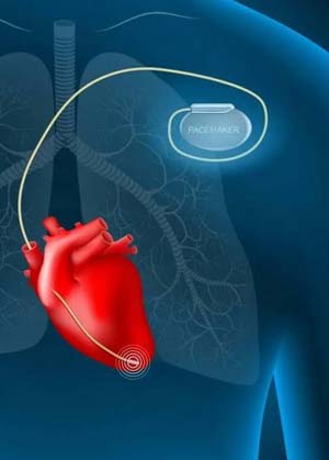 Smartwatch tracking heart rhythm for pacemaker patients